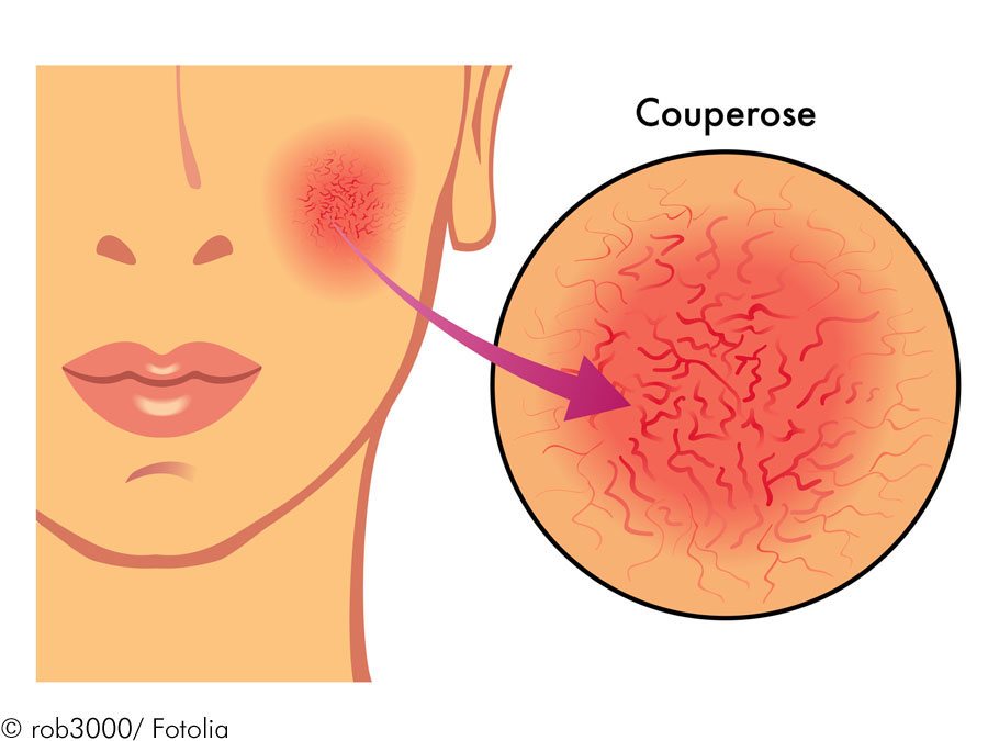 Hilfe: Gerötete Haut! Neigung zu Couperose!-Bild-01